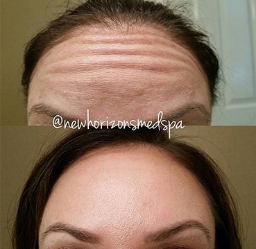 botox Before & After Photos 1