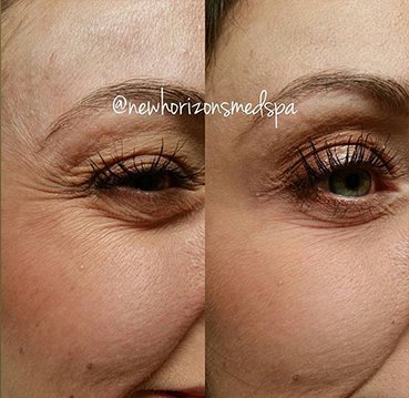 botox Before & After Photos 2