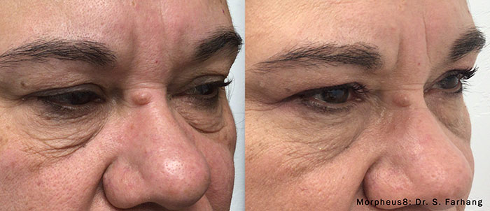 Woman's face, before and after Morpheus8 treatment, oblique view, patient 3