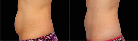 Before and After Photos: front view, 16 Weeks After Second CoolSculpting Session, Photos Courtesy of Grant Stevens, MD, FACS