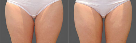Before and After Photos: 5 Weeks After CoolSculpting Session (front view), Photos Courtesy of Dr.Tracy Mountford