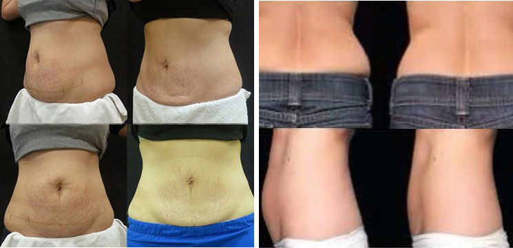 Before and After Treatment Photos: CoolSculpting Patients