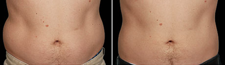 Before and After Photos: side view, 12 Weeks After Second CoolSculpting Session, Photos Courtesy of Amy Brodsky, MD